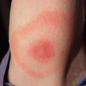 Erythema Migram, a sign of Lyme disease